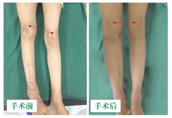 女孩墜梯右腿縮短5cm，幸得醫(yī)生及時診治恢復(fù)正常腿型