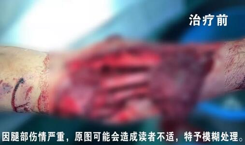 感謝安利醫(yī)院挽救了我的腿，沒有讓我落下殘疾……”