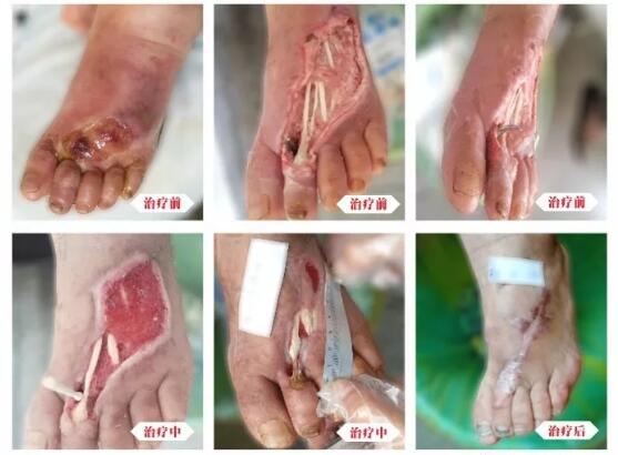 糖尿病并發(fā)癥有多可怕，及時治療糖尿病足避免截肢！