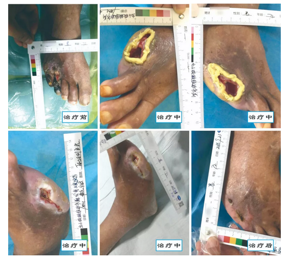 介入治療糖尿病足，您聽說過沒？