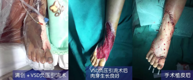 車禍猛如虎，救治如“華佗” ，手術(shù)＋康復(fù)，8歲小女孩車禍后日漸康復(fù)行走