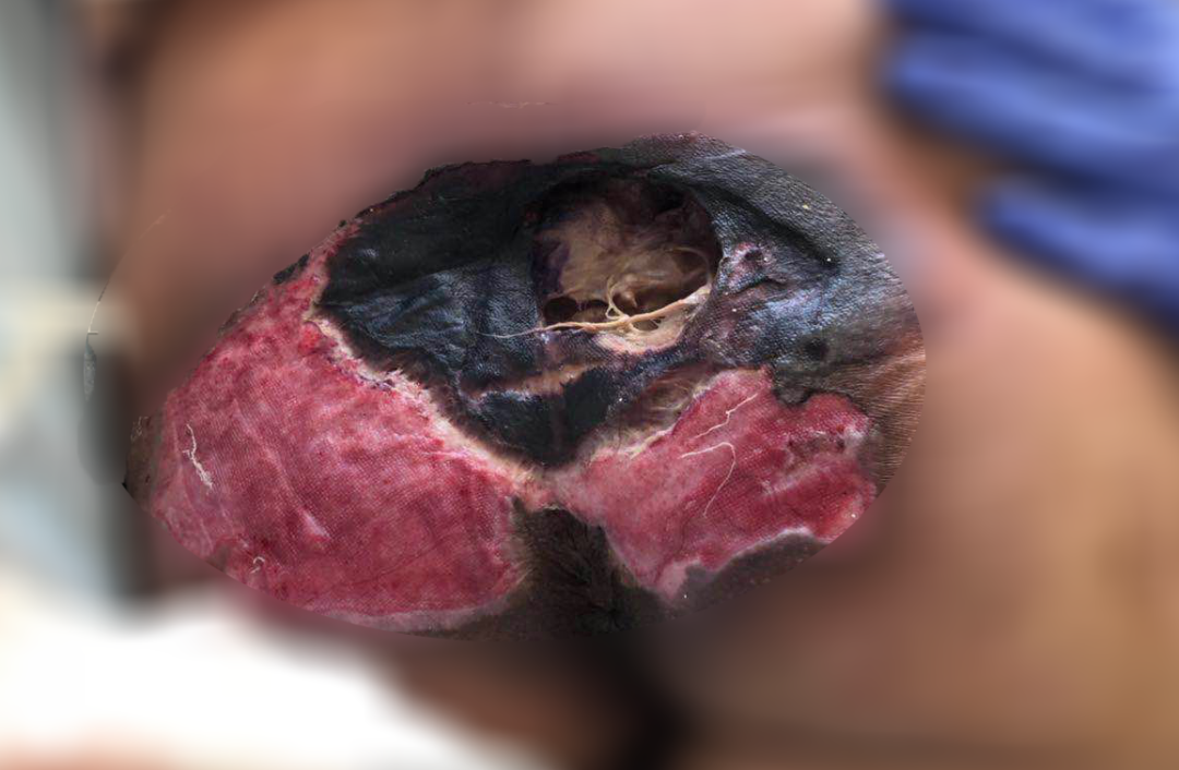癱瘓3年的女患者臀部居然變成這樣?！