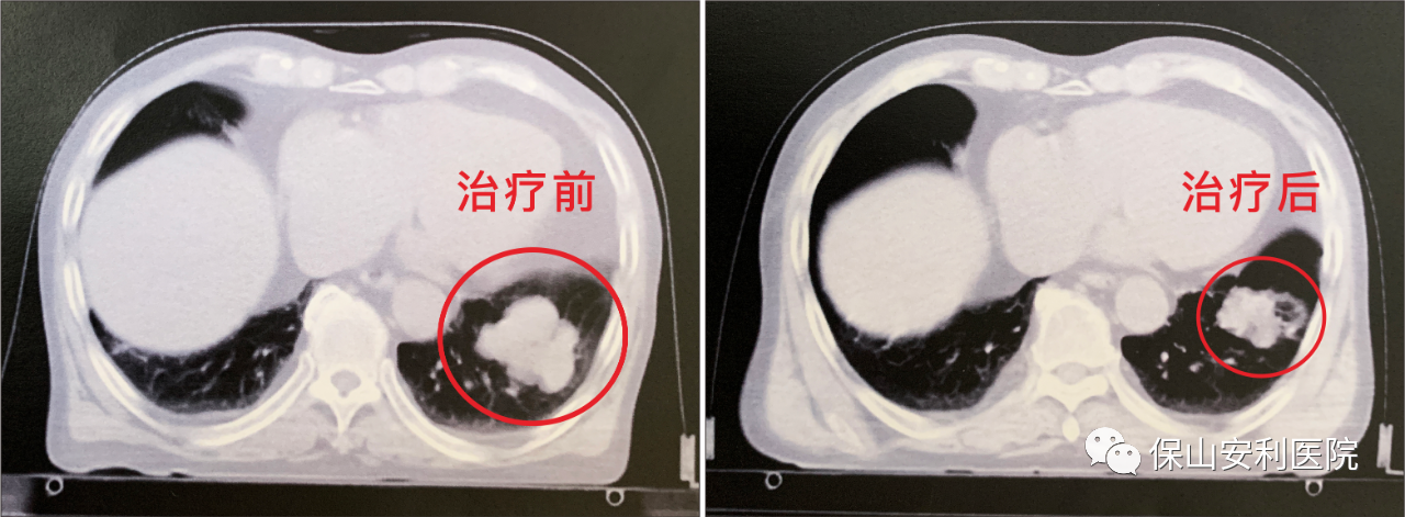 不做手術(shù)，早期肺癌也能根治！