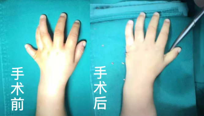 【保山安利醫(yī)院】2歲小兒手、足多指（趾）成功修復(fù)(矯正）！