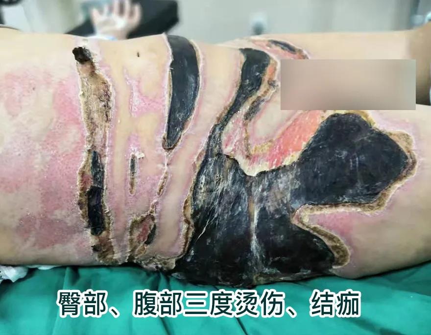 【保山安利醫(yī)院】80歲老人不慎燒傷，導(dǎo)致腹部、右側(cè)臀部大面積創(chuàng)傷，經(jīng)植皮治療創(chuàng)面逐漸愈合