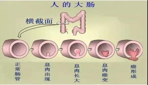 體檢發(fā)現(xiàn)腸息肉會(huì)癌變嗎？