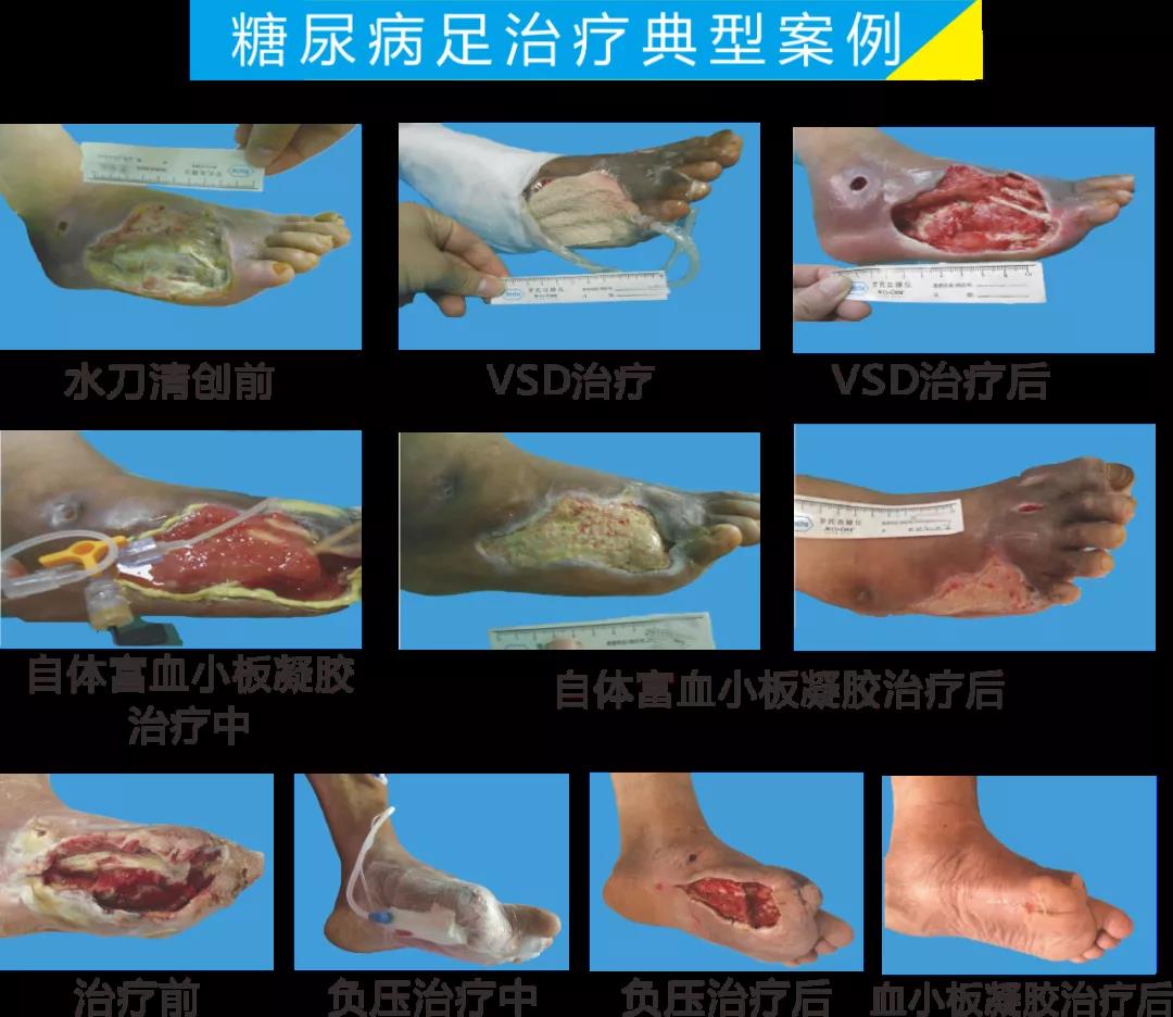 截肢、失明，甚至……，我們要做的是將糖尿病并發(fā)癥遏制在搖籃里！