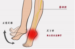 【保山安利醫(yī)院—健康科普】什么是足下垂！你了解嗎？