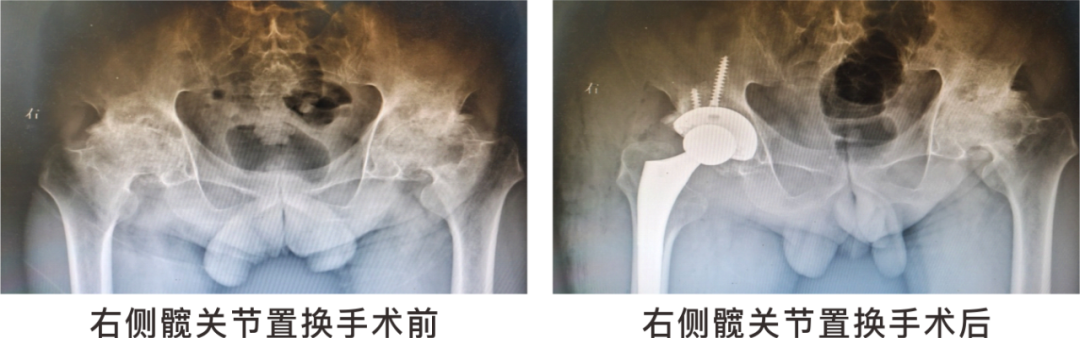 【保山安利醫(yī)院】長期飲酒導(dǎo)致雙側(cè)股骨頭壞死，髖關(guān)節(jié)置換后重獲運(yùn)動(dòng)功能！