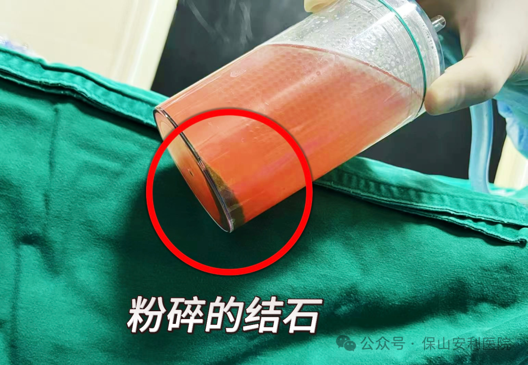 科普丨泌尿結(jié)石“克星”鈥激光碎石術(shù)，手術(shù)動(dòng)圖揭秘全過程！